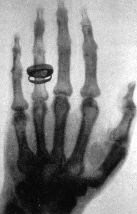 Une des premières radiographies faites par Wilhelm Röntgen